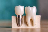 Dental implants in Islamabad Enfield Royal Clinics