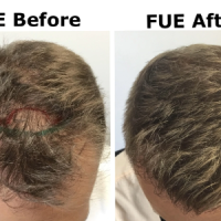 FUE Hair Transplant in Islamabad Enfield Royal Clinics