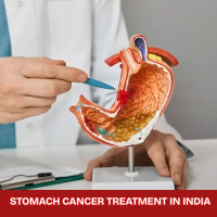 Low Cost Stomach Cancer Treatment in India
