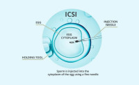 ICSI Treatment in Delhi - Dr Rhythm Gupta