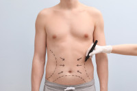 Abdominoplasty in Islamabad