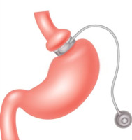 gastric sleeve surgery